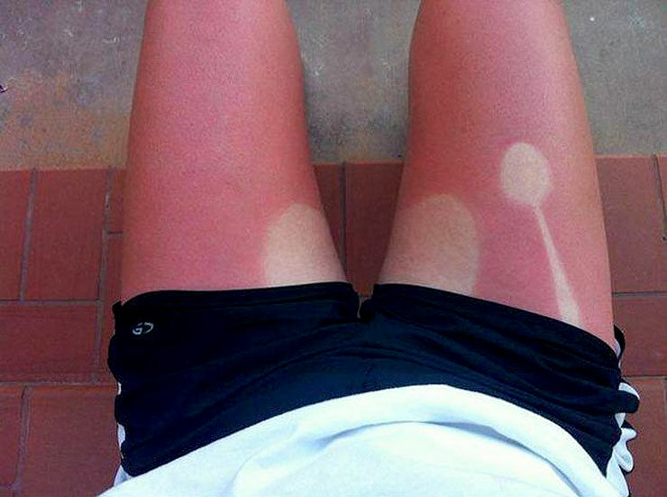 These People Stayed Out In The Sun A Little Too Long And Look What Happened