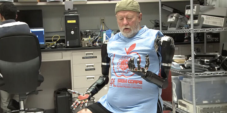 Amputee Makes History With Mind-Controlled Cyborg Arms
