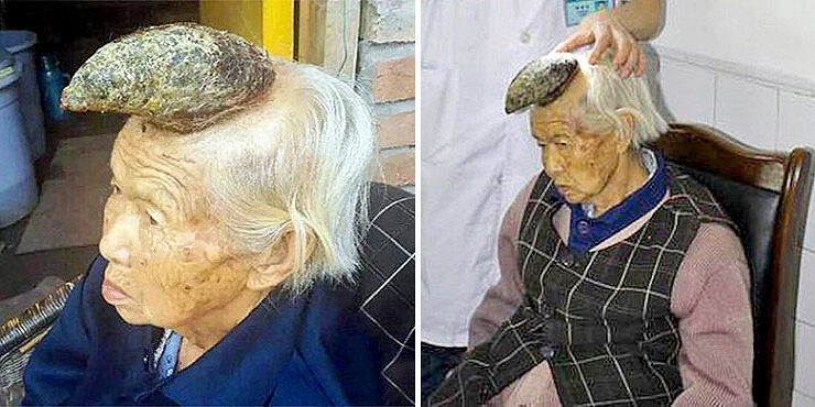 87-Year-Old Woman Has Huge Horn Growing From Her Head