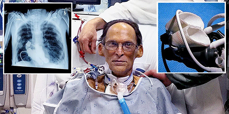 Man With Artificial Heart Is Only Human To Live Without Pulse