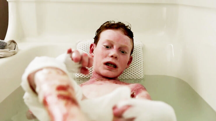 Epidermolysis Bullosa Butterfly Boy Jonathan Pitre 04.