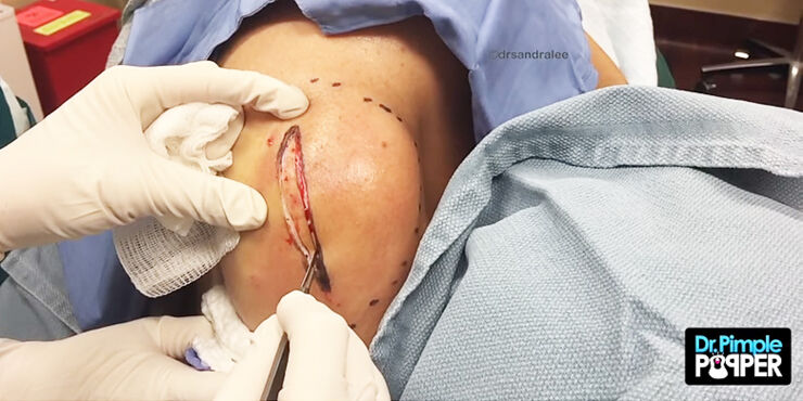 Dr Pimple Popper lipoma 01.